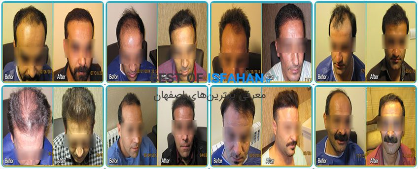 بهترین مرکز کاشت مو در اصفهان؟ معرفی بهترین کلینیک کاشت مو اصفهان (1405) 10 کلینیک تخصصی کاشت موی طبیعی، لیزر و لاغری آفتاب (دکتر رجالی)