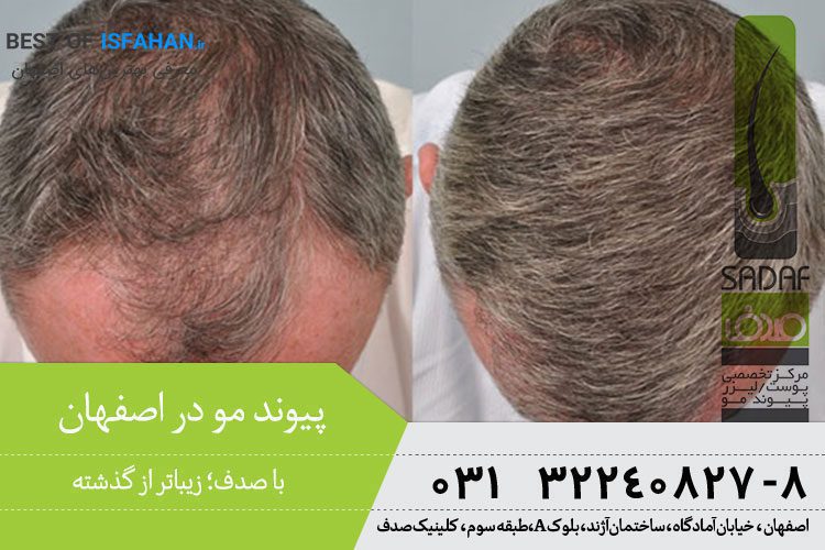 بهترین مرکز کاشت مو در اصفهان؟ معرفی بهترین کلینیک کاشت مو اصفهان (1405) 4 کلینیک صدف (مرکز تخصصی پوست، لیزر و پیوند مو)